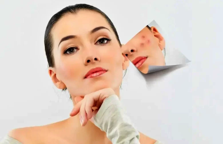 حب الشباب الهرموني