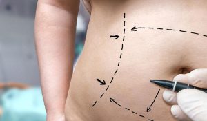 حول جراحات التجميل لشد ترهلات الجلد