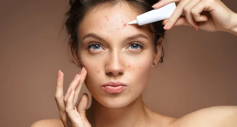 ماهو حمض الساليسيليك؟ ماهو حمض الساليسيليك؟