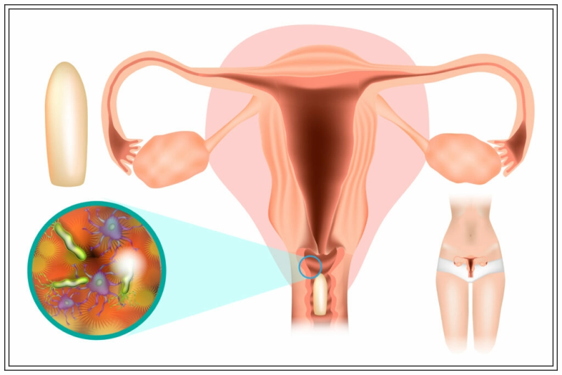 كيف تحدث الإصابة بإلتهاب المهبل الجرثومي؟
