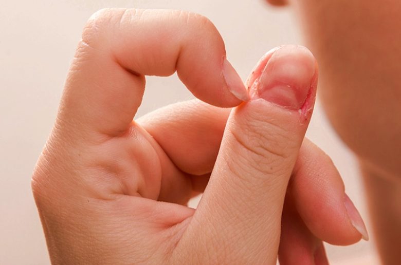 اضطراب قطف الجلد.. أعراضه وأسبابه وطرق علاجه اضطراب قطف الجلد.. أعراضه وأسبابه وطرق علاجه