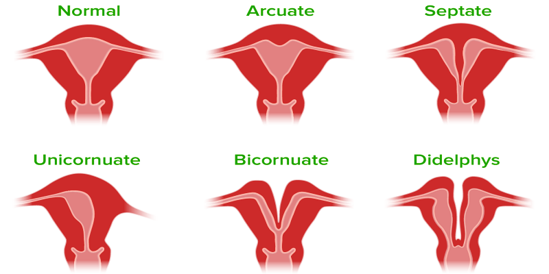 ما هي أهم أنواع تشوهات الرحم؟