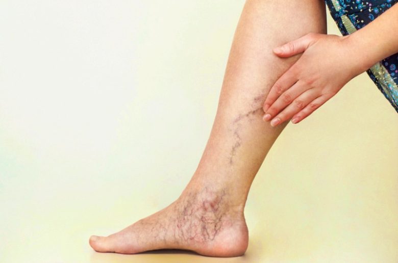 الدوالي.. الأعراض والأسباب وطرق العلاج