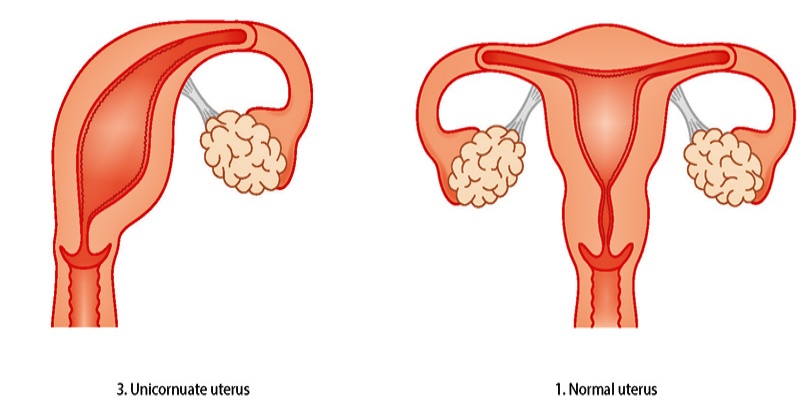 رابعا: الرحم ذو القرن الواحد