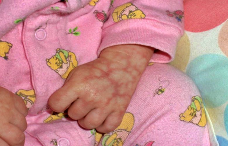 جلد الرضيع الرخامي وأهم المعلومات عنه