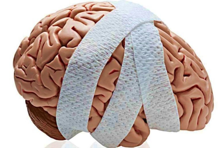 متلازمة ما بعد الارتجاج