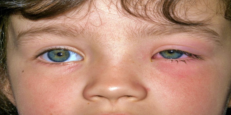 ما هو مرض العين الوردية (التهاب الملتحمة)؟