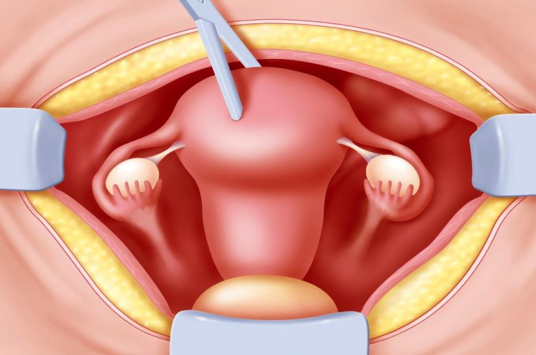 إجراء التوسيع والكشط بعد الإجهاض إجراء التوسيع والكشط بعد الإجهاض