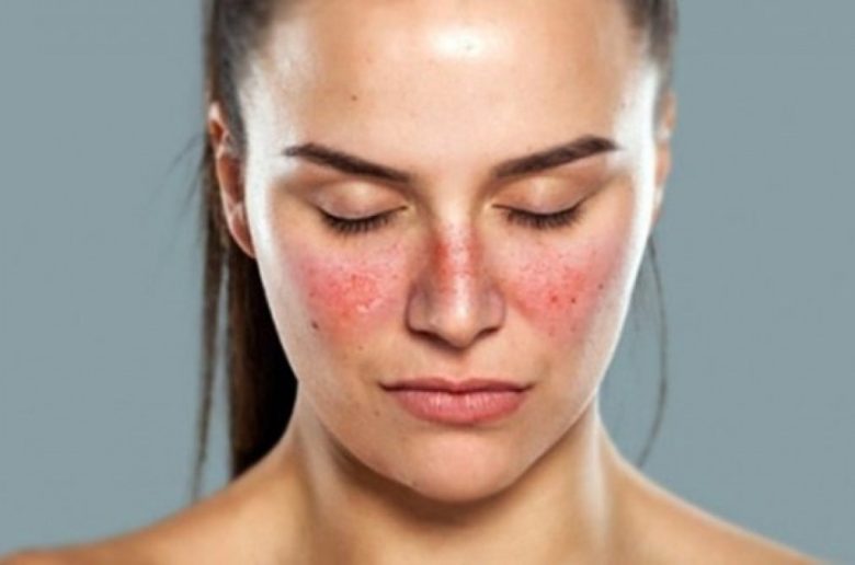 العلاجات الطبيعية لتخفيف أعراض مرض الذئبة الحمراء