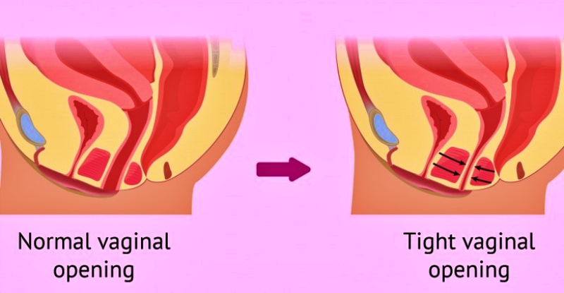 ما هو التشنج المهبلي؟