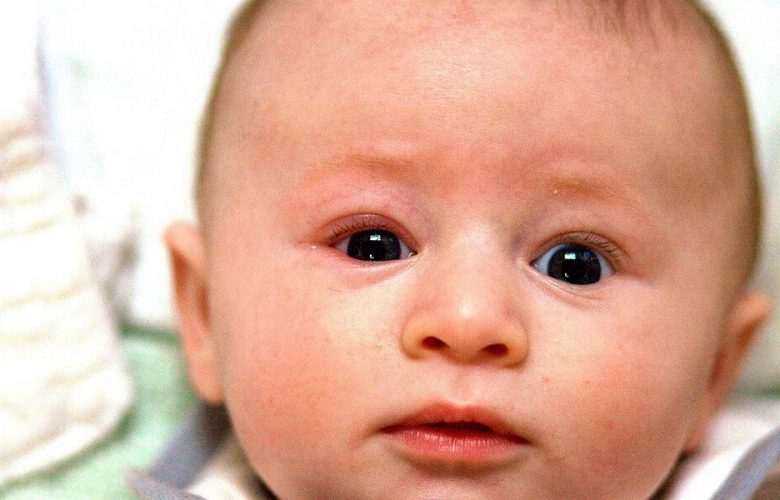 انسداد الغدة الدمعية عند حديثي الولادة