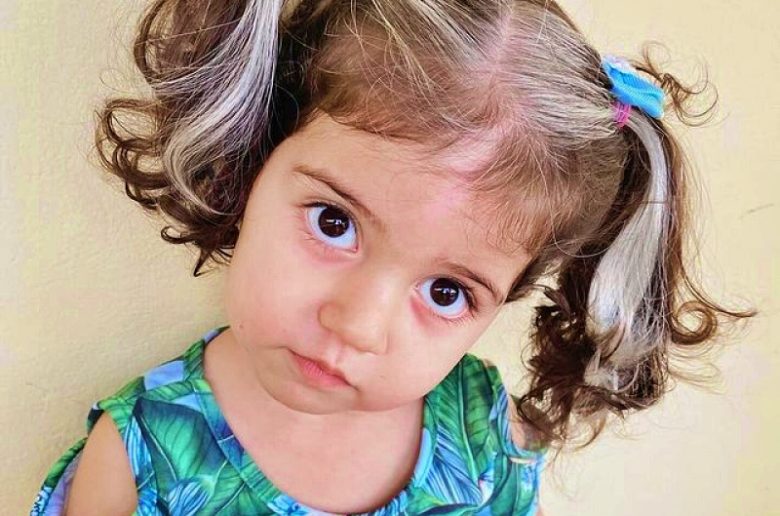 الشيب المبكر عند الأطفال