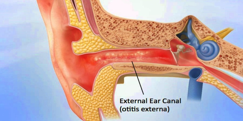 ما هو التهاب قناة الأذن الخارجية؟