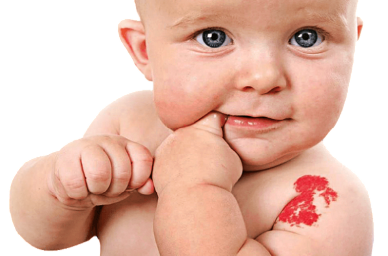 الأورام الوعائية عند الأطفال حديثي الولادة