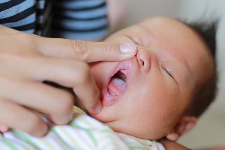 تقرحات الشفاة عند الرضع