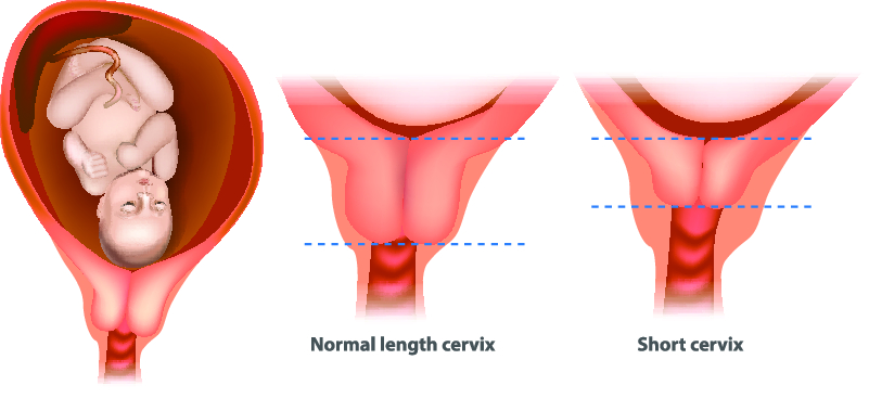 ما هو عنق الرحم القصير؟