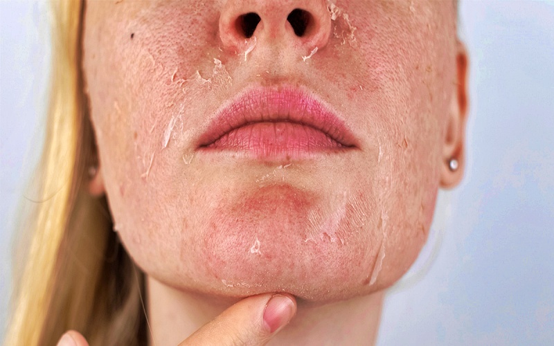 تقشير الجلد الجاف حول الفم.. أهم الأسباب وطرق العلاج