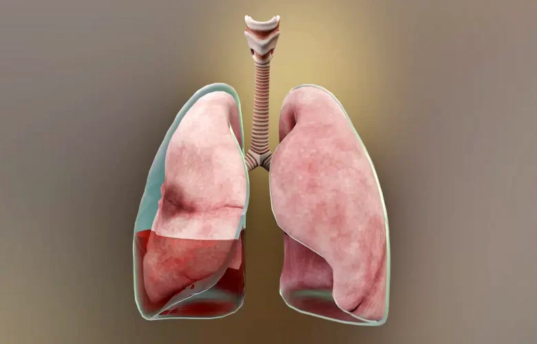 الإنصباب الجنبي