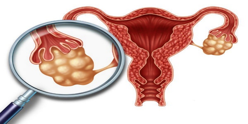 متلازمة المبيض المتعدد الكيسات (PCOS)