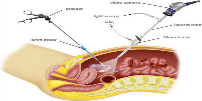 استئصال الرحم الجزئي بالمنظار
