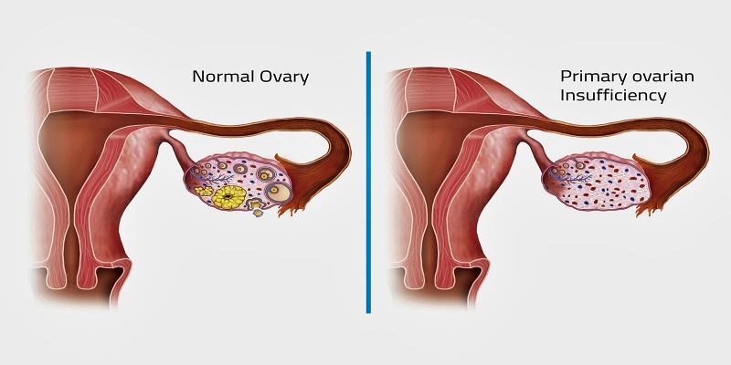 فشل المبيض الأولي