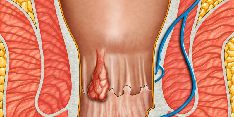 البواسير الداخلية