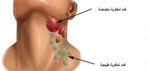 أسباب التهاب الأوعية اللمفية