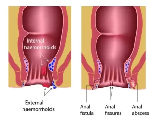 الخراج الشرجي عند الأطفال