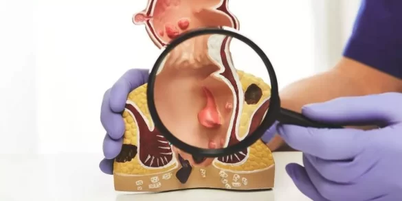 الخراج الشرجي عند الأطفال