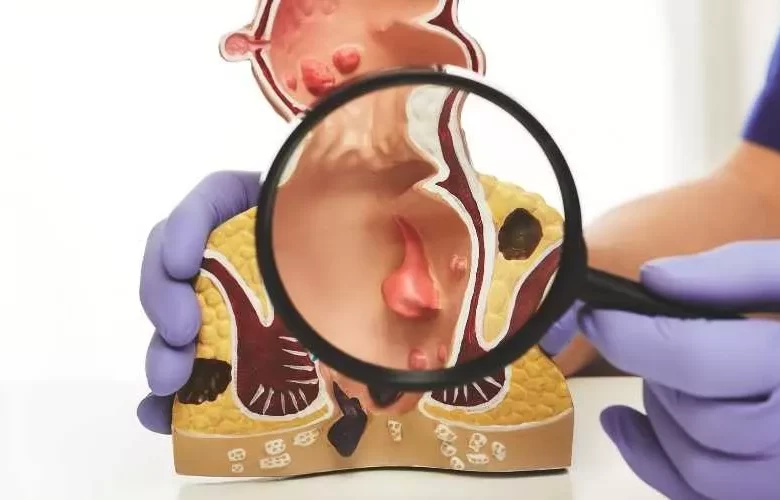 الخراج الشرجي عند الأطفال