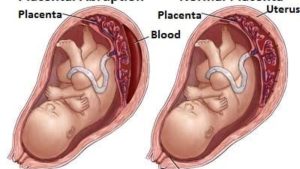 حول ضائقة الجنين أثناء الحمل والولادة