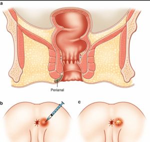 كيف يتم علاج خراج الشرج؟
