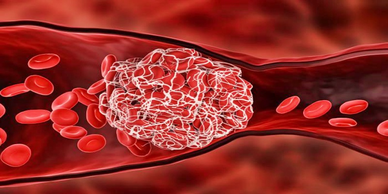 زيادة فرص الإصابة بالجلطات الدموية