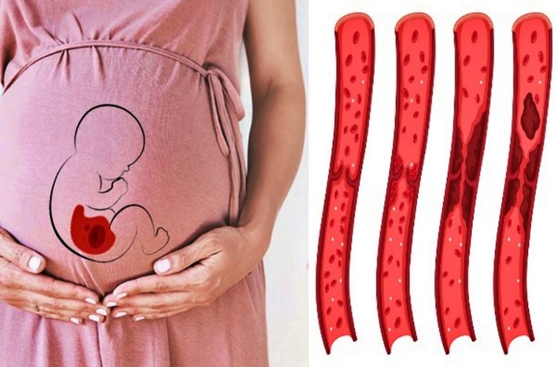 إضطرابات تخثر الدم ومدى خطورتها على المرأة الحامل