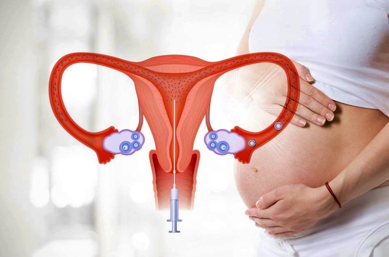 التلقيح داخل الرحم (IUI)