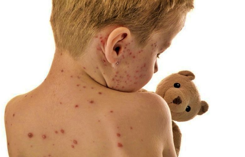 أهم 9 أمراض جلدية وارد تعرض الأطفال لخطر الإصابة بها