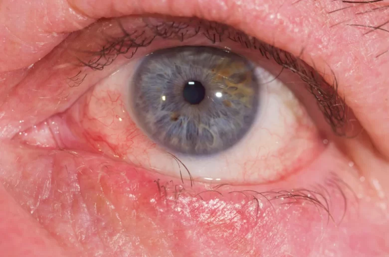 ما هي الرموش الناشبة؟ أسباب الحدوث وطرق العلاج