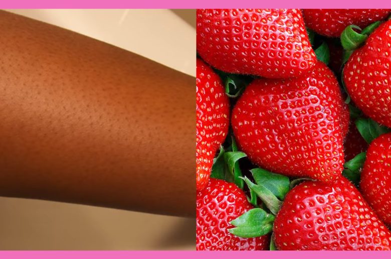 العلاجات المنزلية لأرجل الفراولة