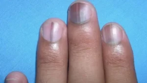 الأظافر الزرقاء