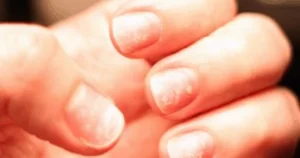 الأظافر المتقشرة