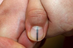 الأظافر ذات الخطوط العمودية السوداء 