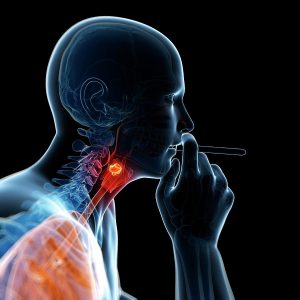 سرطان الأحبال الصوتية والرئة والغدة الدرقية