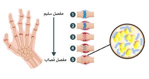 ما هي أسباب التهاب المفاصل الجرثومي؟