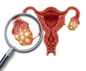 متلازمة تكيس المبايض (PCOS)