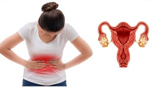 متلازمة فرط تحفيز المبيض