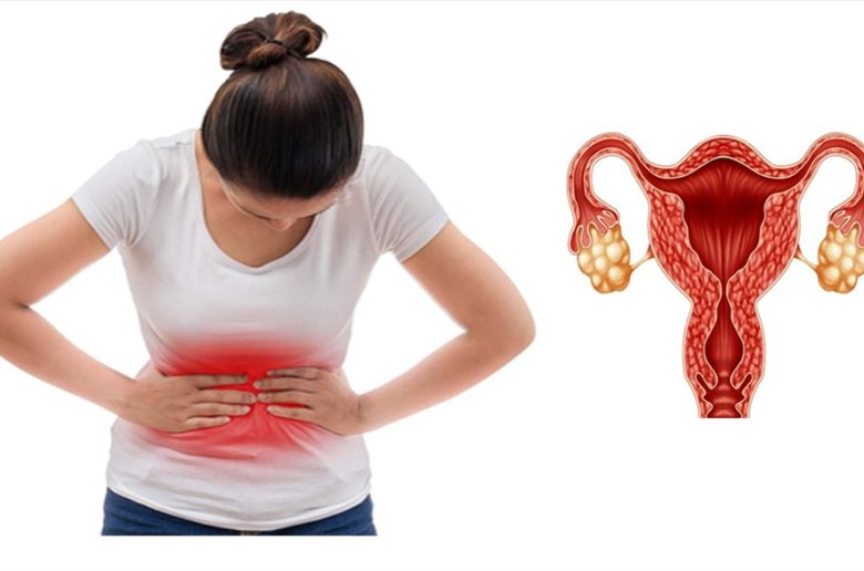 متلازمة فرط تحفيز المبيض