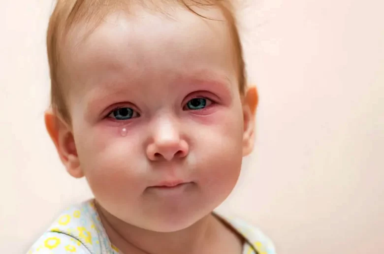 التهاب الجفون عند الأطفال الصغار وكيفية التعامل معه التهاب الجفون عند الأطفال الصغار وكيفية التعامل معه