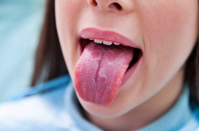 ما هو التهاب اللسان المهاجر؟ وكيف تتم العناية به؟ ما هو التهاب اللسان المهاجر؟ وكيف تتم العناية به؟