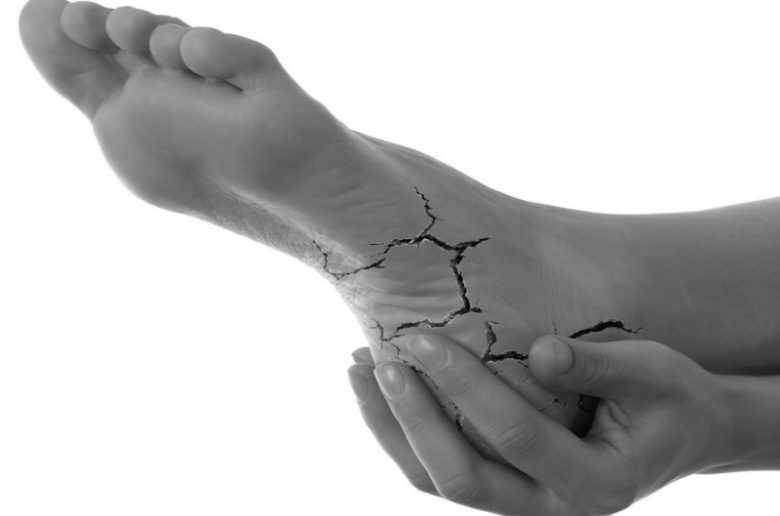 الكعب المتشقق وأهم 3 فيتامينات هامة لعلاجه 