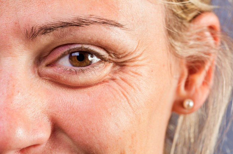 تجاعيد أقدام الغراب.. ما هي؟ وأهم الطرق الفعالة لعلاجها